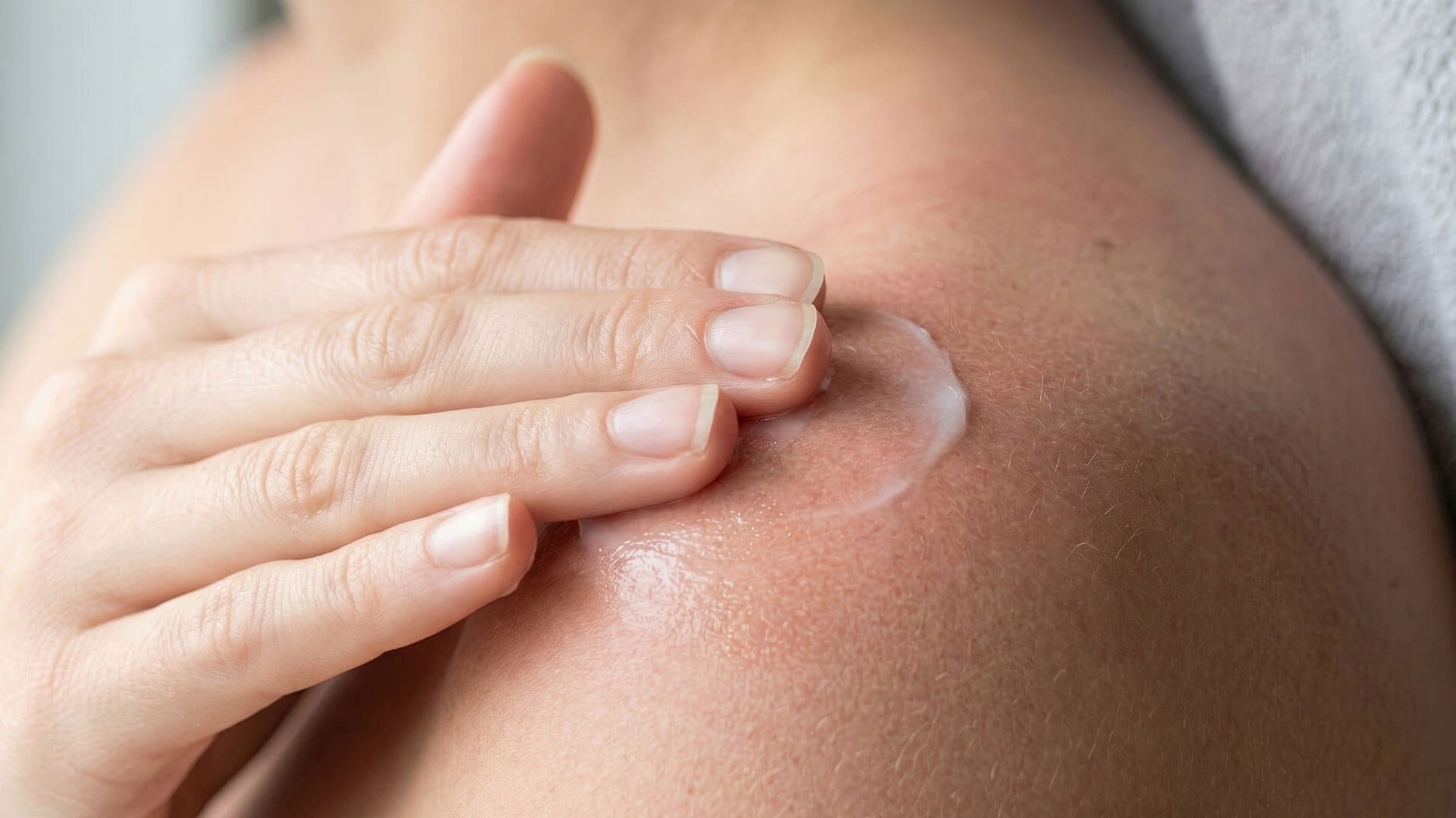 Does Hemp Lotion Help with Sunburn? Yes. Here Is What to Look For.