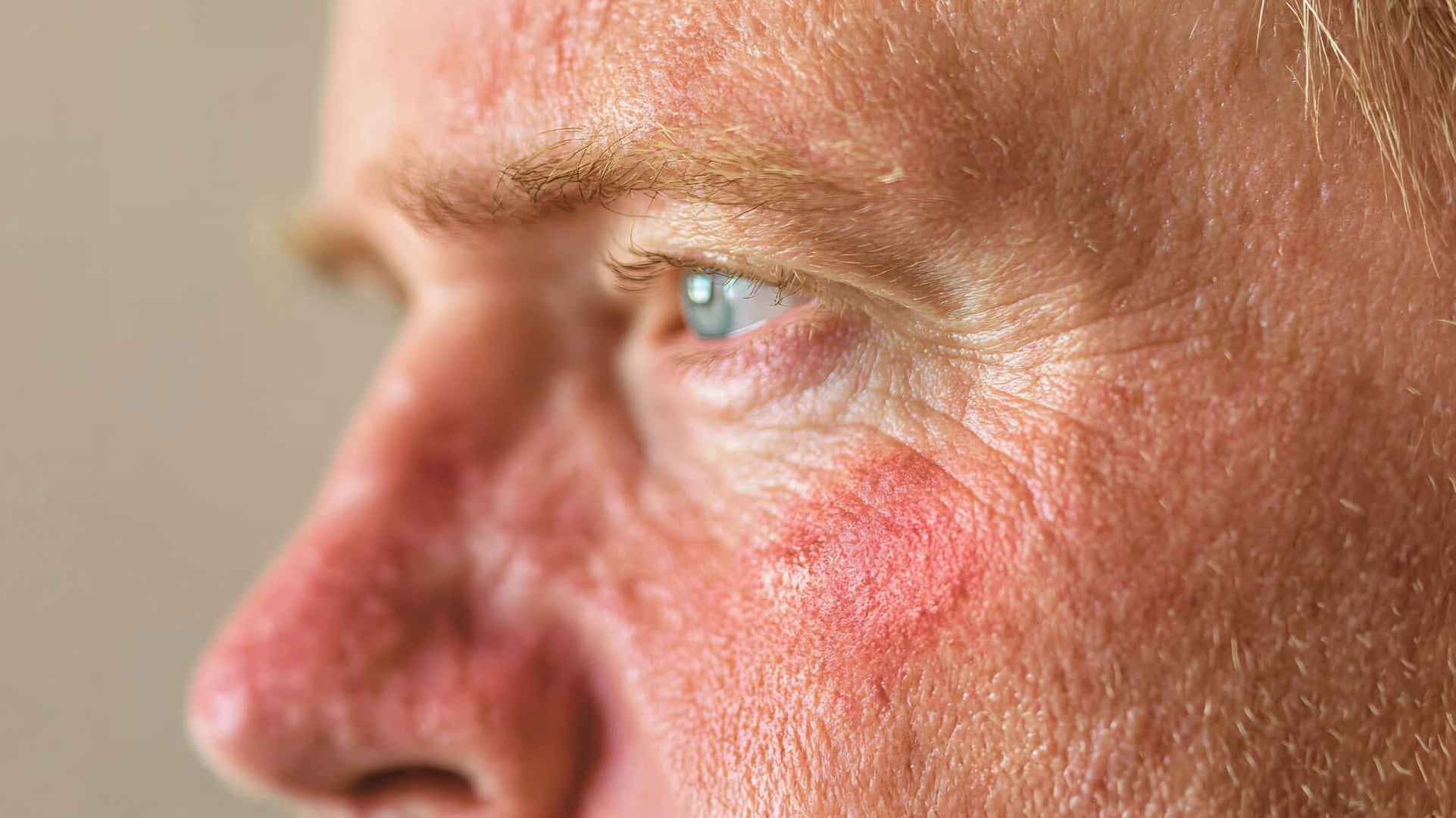 Best Sunscreen for Rosacea