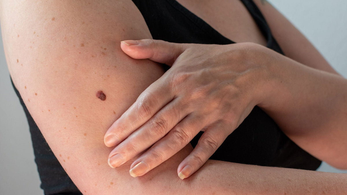 How to Check Your Skin After Summer: A Mohs Surgeon's Step-by-Step Self-Exam