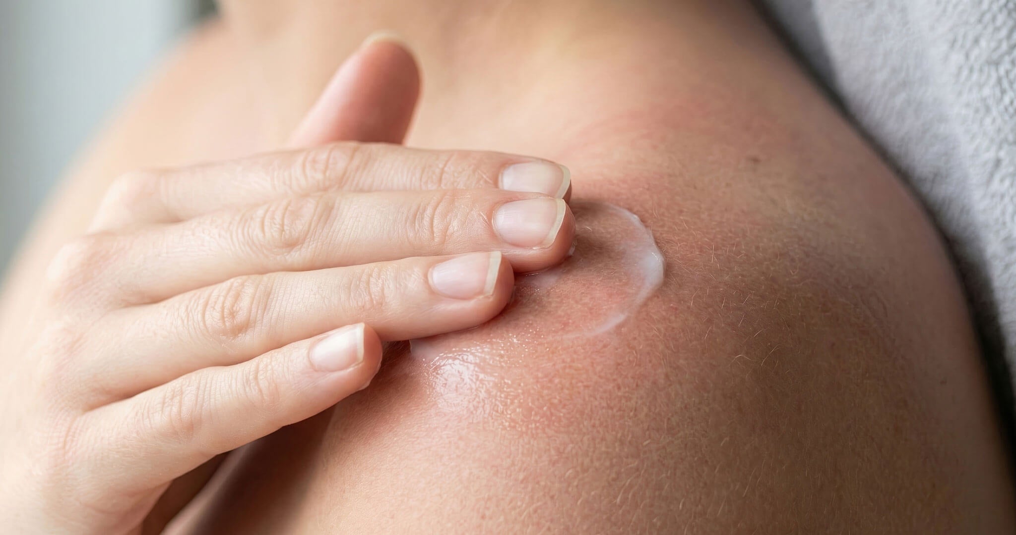 Does Hemp Lotion Help with Sunburn? Yes. Here Is What to Look For.