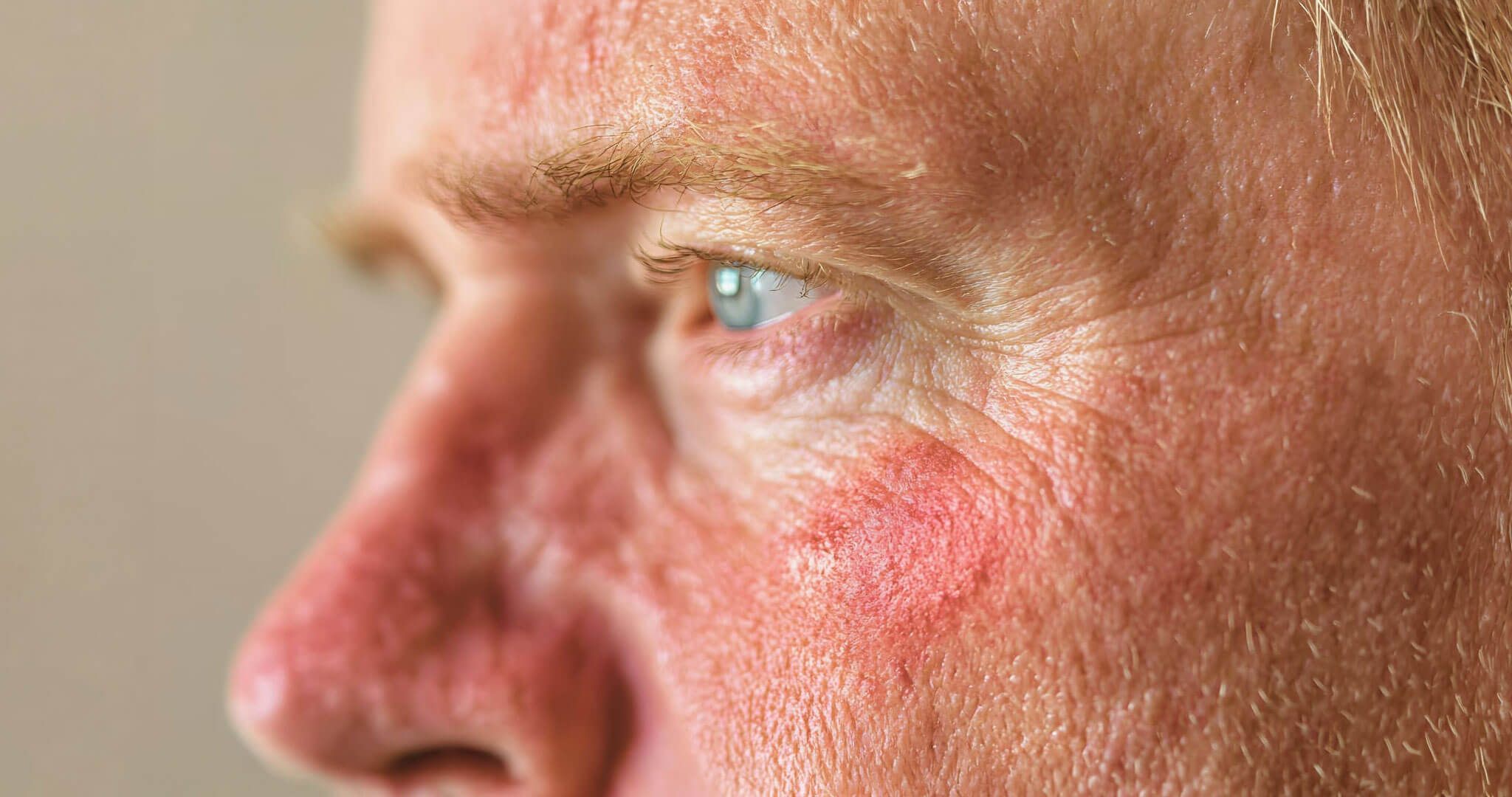 Best Sunscreen for Rosacea