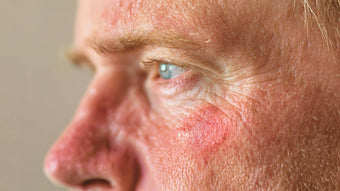 Best Sunscreen for Rosacea