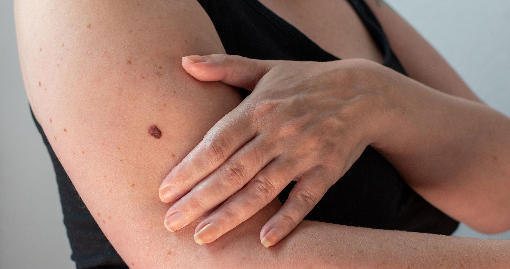 How to Check Your Skin After Summer: A Mohs Surgeon's Step-by-Step Self-Exam