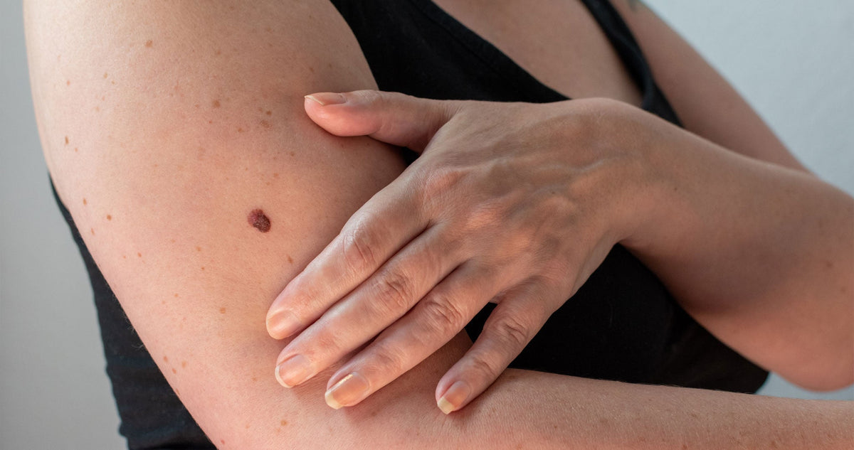 How to Check Your Skin After Summer: A Mohs Surgeon's Step-by-Step Self-Exam
